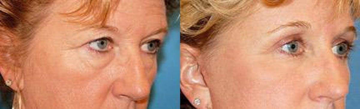 Skin Resurfacing Before & After Gallery - Patient 122406704 - Image 1