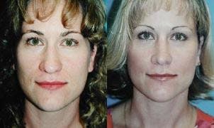Rhinoplasty Before & After Gallery - Patient 122406708 - Image 1