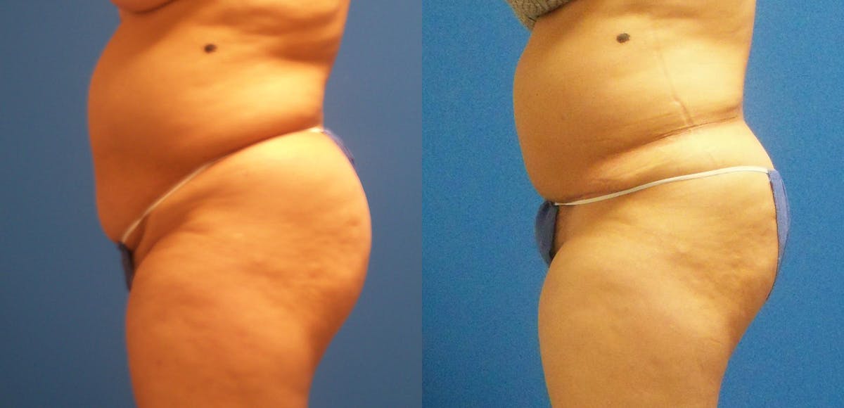 Tummy Tuck Before & After Gallery - Patient 417938 - Image 3