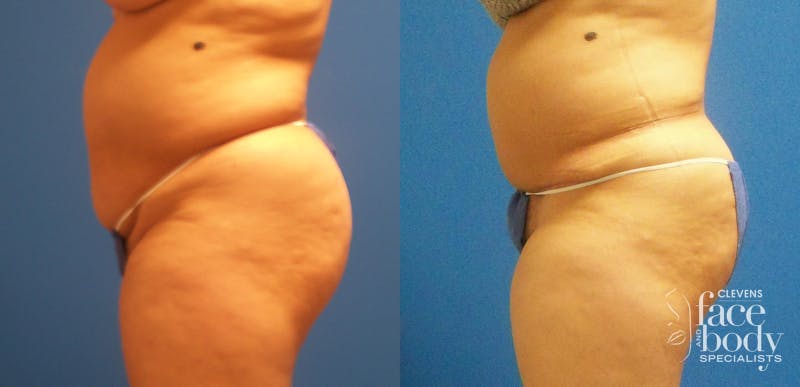 Hidden Tummy Tuck Before & After Gallery - Patient 229942 - Image 3