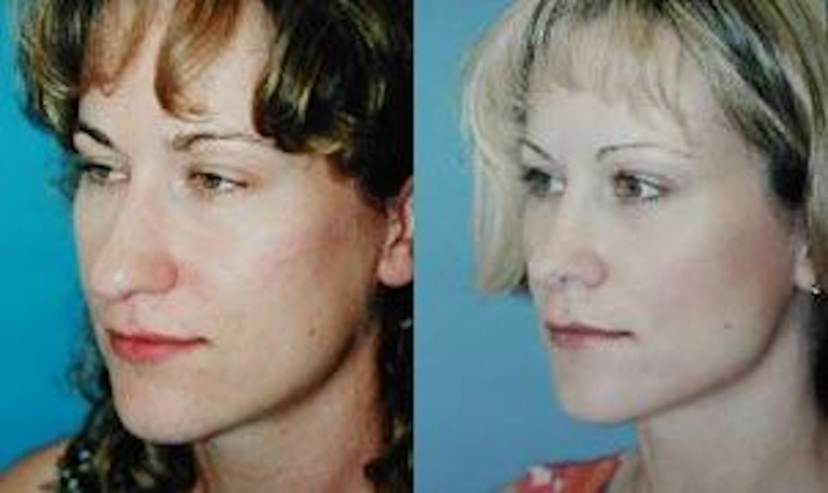 Rhinoplasty Before & After Gallery - Patient 122406708 - Image 2