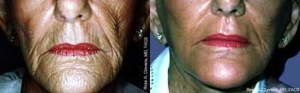 Skin Resurfacing Before & After Gallery - Patient 122406707 - Image 1