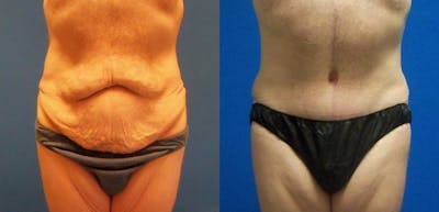 Tummy Tuck Before & After Gallery - Patient 672523 - Image 1