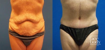Hidden Tummy Tuck Before & After Gallery - Patient 282477 - Image 1