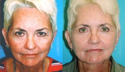 Skin Resurfacing Before & After Gallery - Patient 122406712 - Image 1