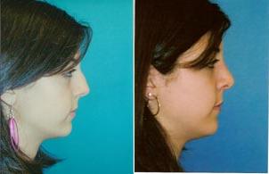 Rhinoplasty Before & After Gallery - Patient 122406711 - Image 1