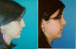 Rhinoplasty Before & After Gallery - Patient 122406711 - Image 1