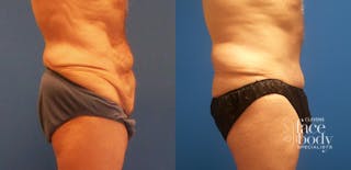 Hidden Tummy Tuck Before & After Gallery - Patient 282477 - Image 2