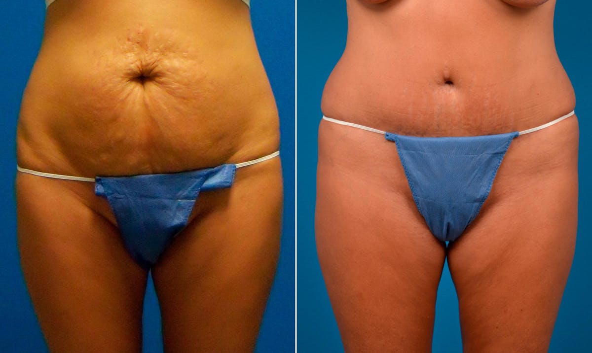 Drainless Tummy Tuck Before & After Gallery - Patient 122406718 - Image 1
