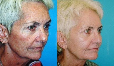 Skin Resurfacing Before & After Gallery - Patient 122406712 - Image 2