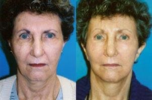 Rhinoplasty Before & After Gallery - Patient 122406716 - Image 1