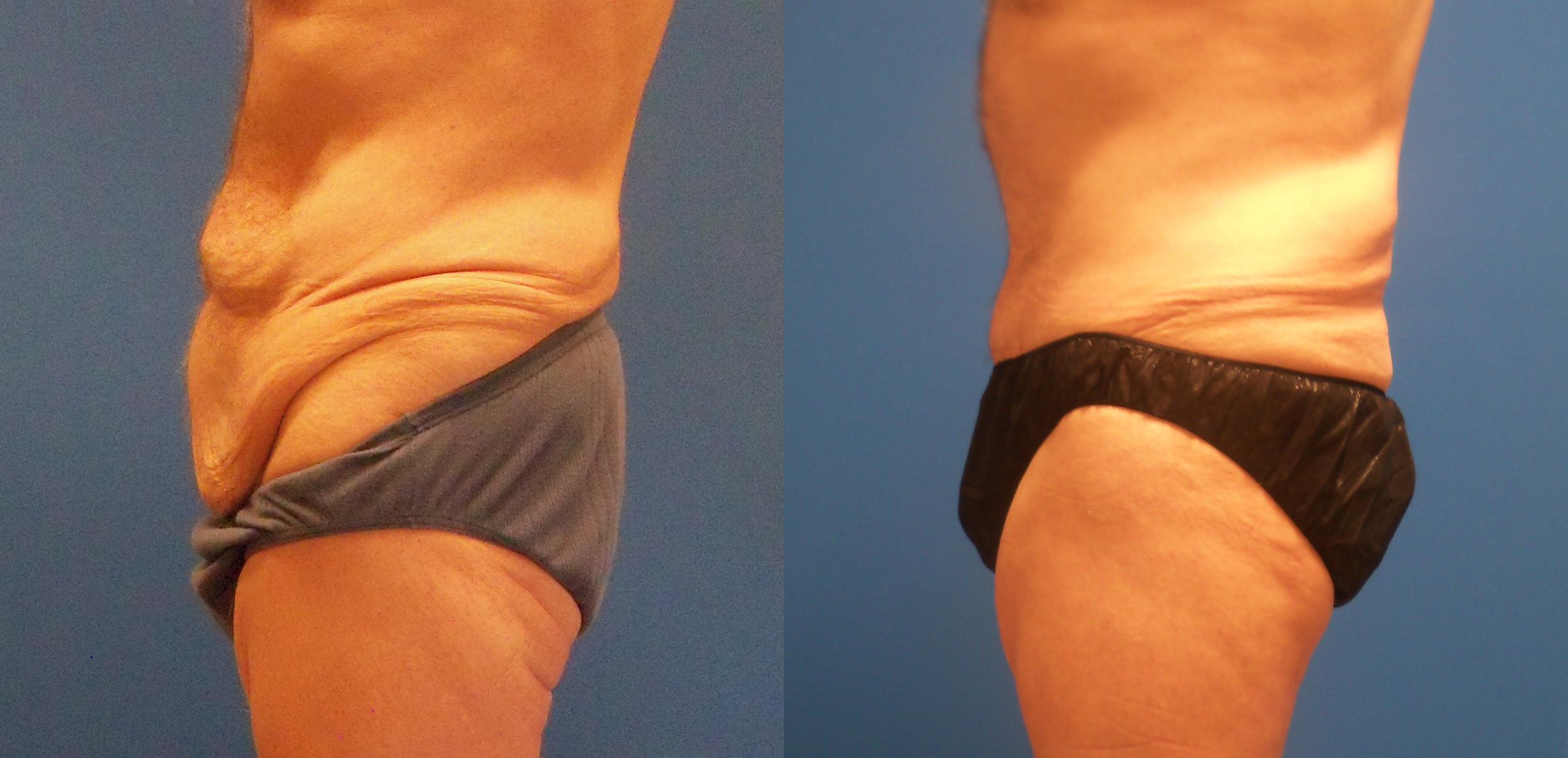 Hidden Tummy Tuck Before & After Gallery - Patient 282477 - Image 3
