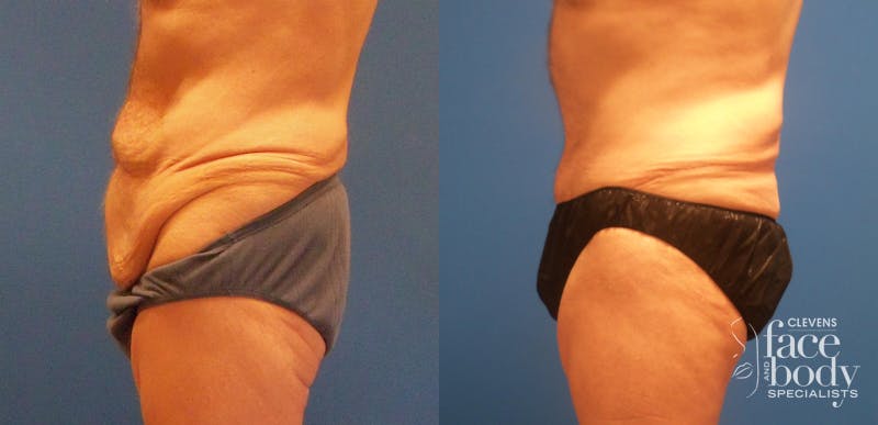 Hidden Tummy Tuck Before & After Gallery - Patient 282477 - Image 3
