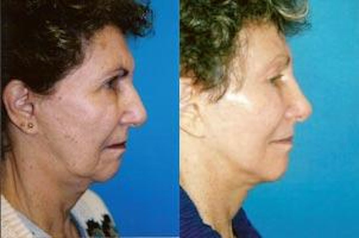 Rhinoplasty Before & After Gallery - Patient 122406716 - Image 2