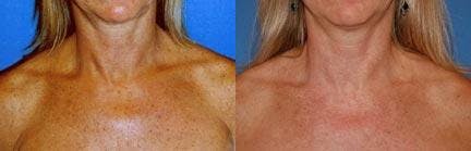 Skin Resurfacing Before & After Gallery - Patient 122406717 - Image 1
