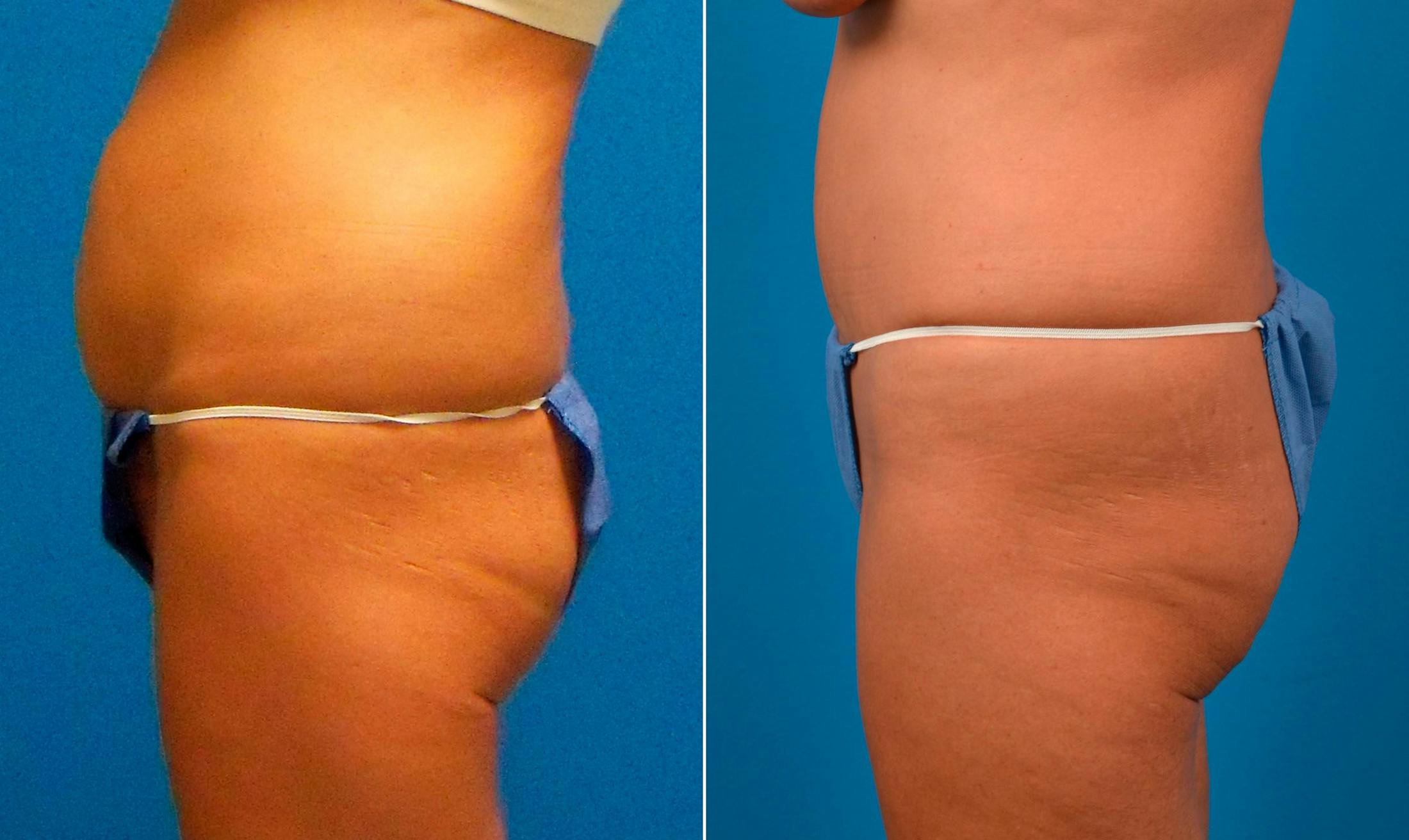 Drainless Tummy Tuck Gallery - Patient 122406718 - Image 3
