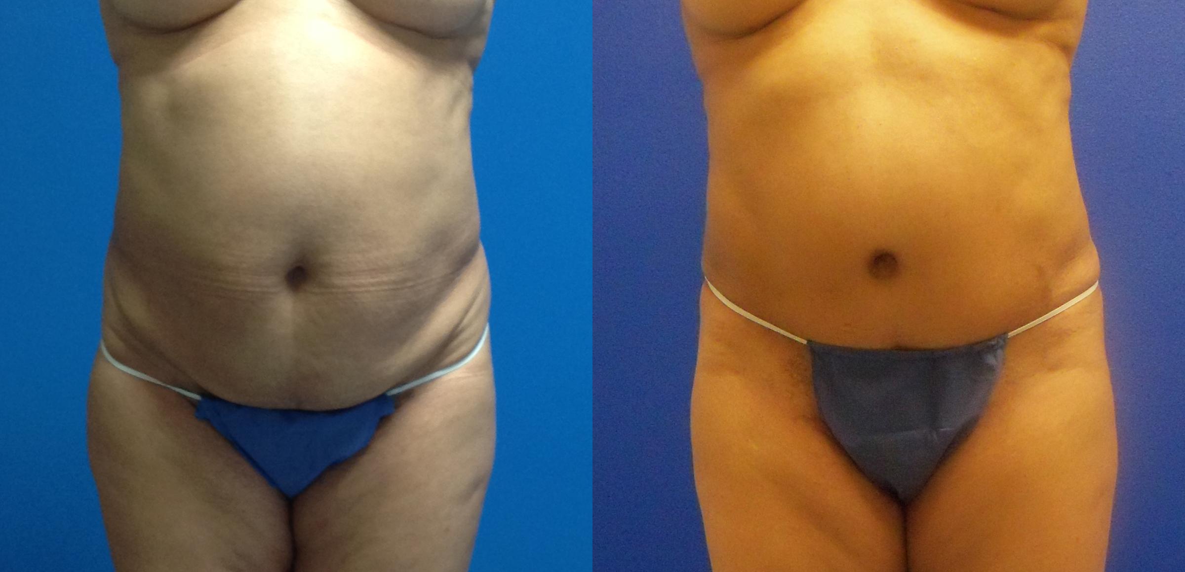 Hidden Tummy Tuck Before & After Gallery - Patient 223176 - Image 1