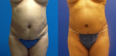 Tummy Tuck Before & After Gallery - Patient 238407 - Image 1