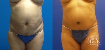 Hidden Tummy Tuck Before & After Gallery - Patient 223176 - Image 1