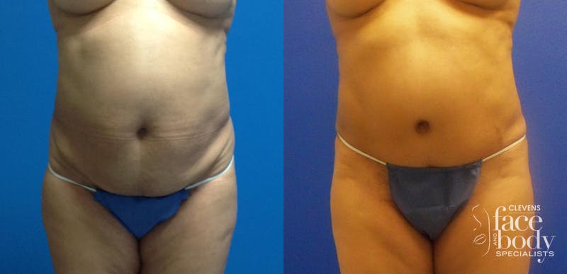 Hidden Tummy Tuck Before & After Gallery - Patient 223176 - Image 1