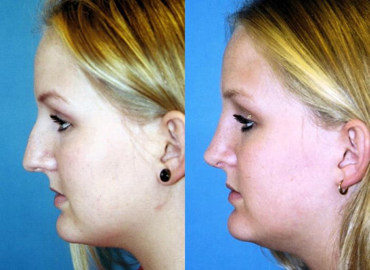 Rhinoplasty Before & After Gallery - Patient 122406719 - Image 1