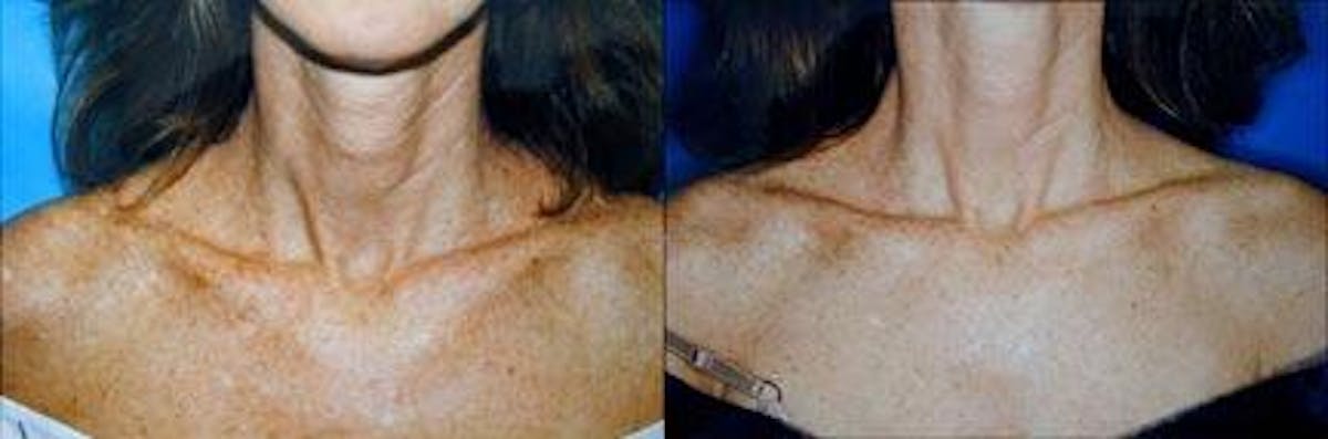 Skin Resurfacing Before & After Gallery - Patient 122406720 - Image 1