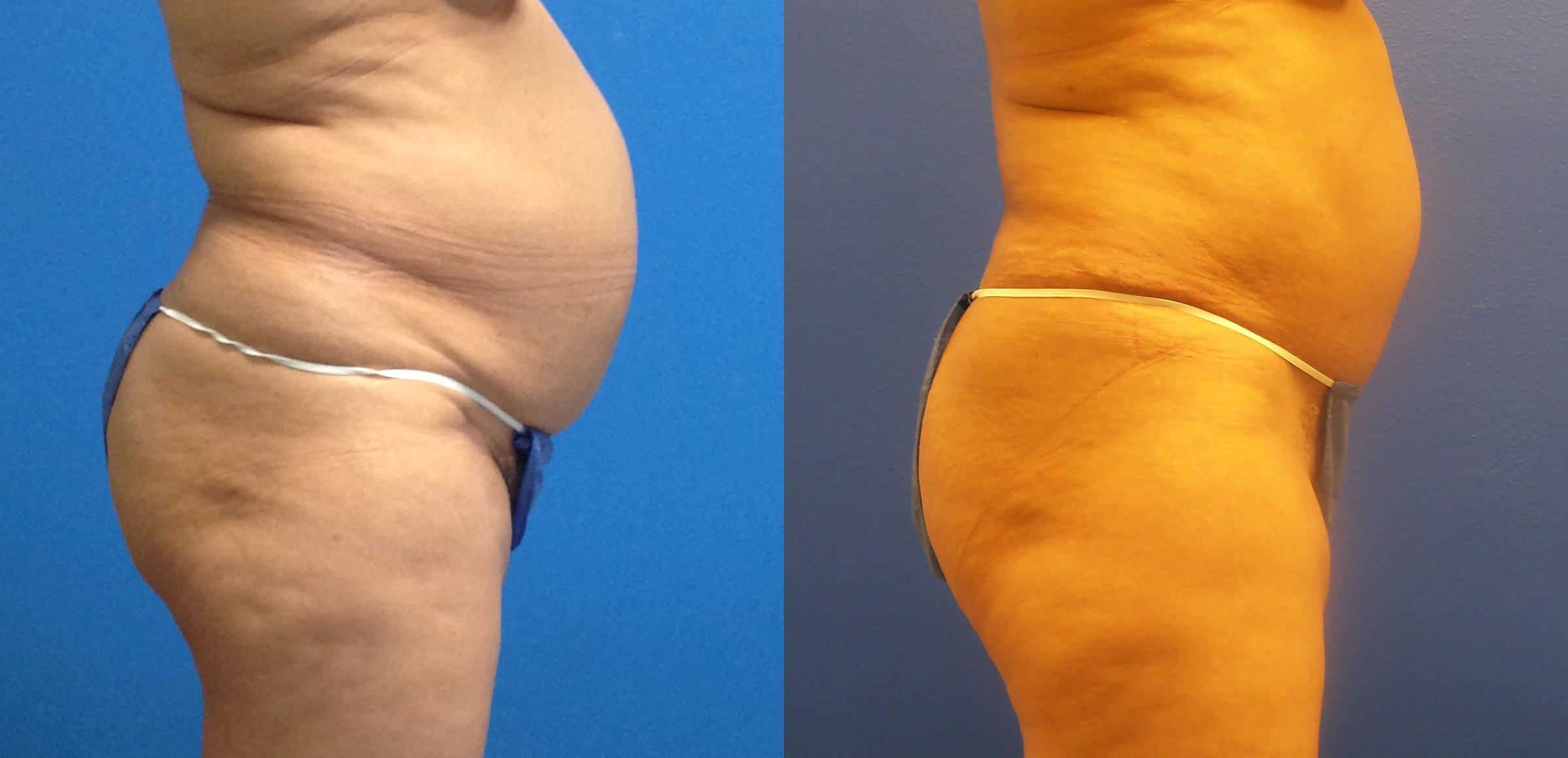 Hidden Tummy Tuck Before & After Gallery - Patient 223176 - Image 2