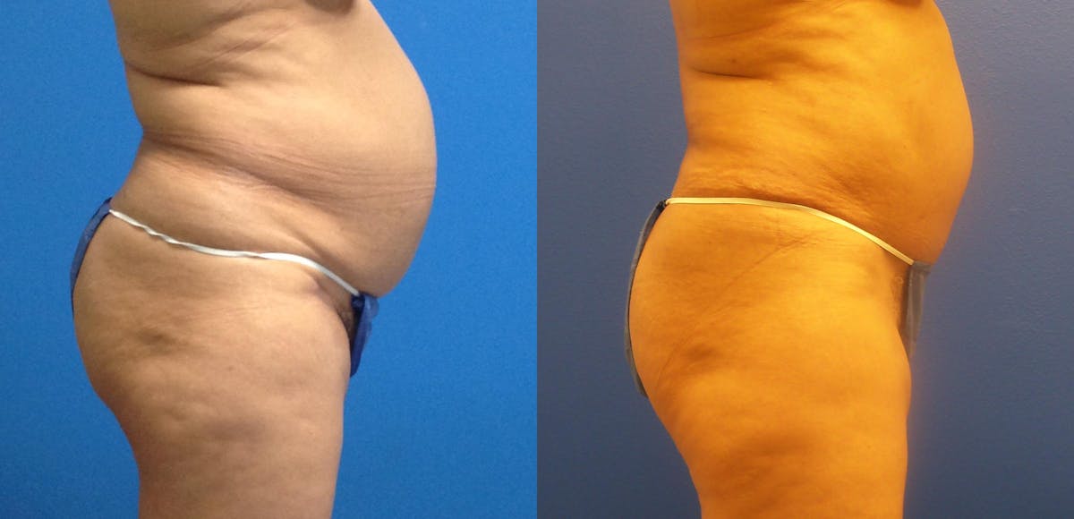 Tummy Tuck Before & After Gallery - Patient 238407 - Image 2