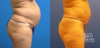Hidden Tummy Tuck Before & After Gallery - Patient 223176 - Image 2