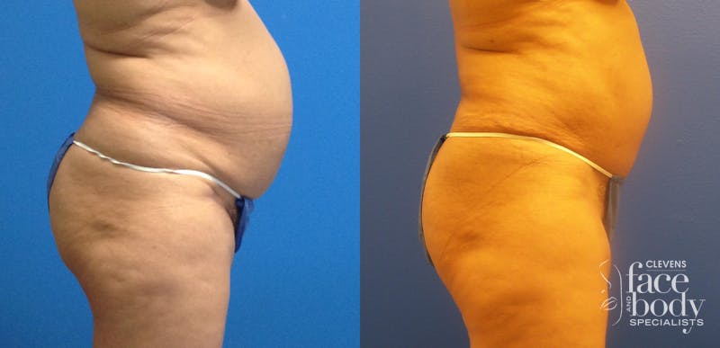 Hidden Tummy Tuck Before & After Gallery - Patient 223176 - Image 2
