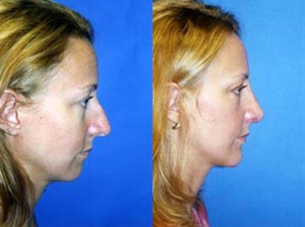 Rhinoplasty Before & After Gallery - Patient 122406721 - Image 1