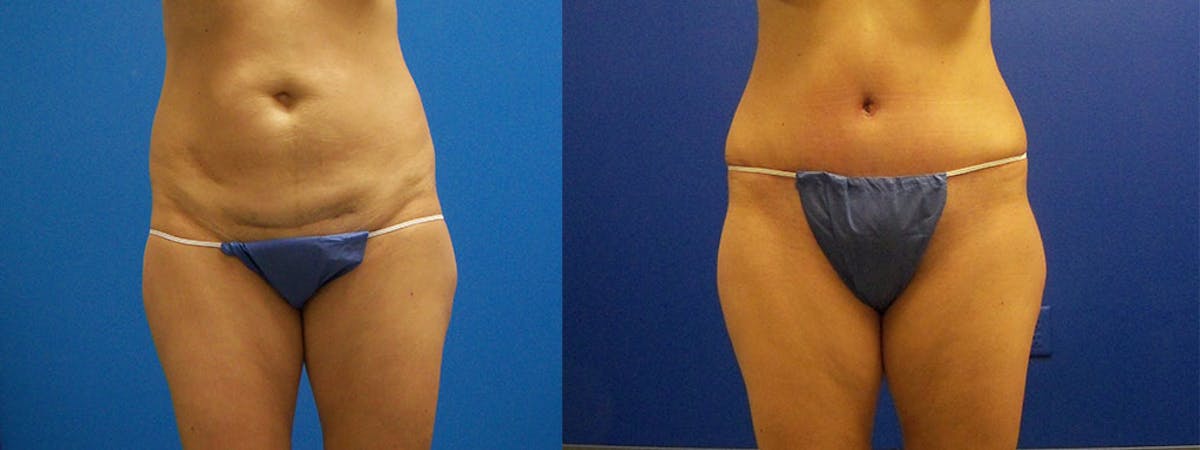 Drainless Tummy Tuck Before & After Gallery - Patient 122406723 - Image 1