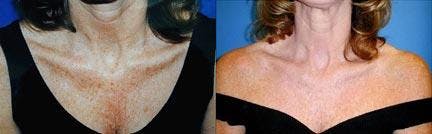 Skin Resurfacing Before & After Gallery - Patient 122406722 - Image 1