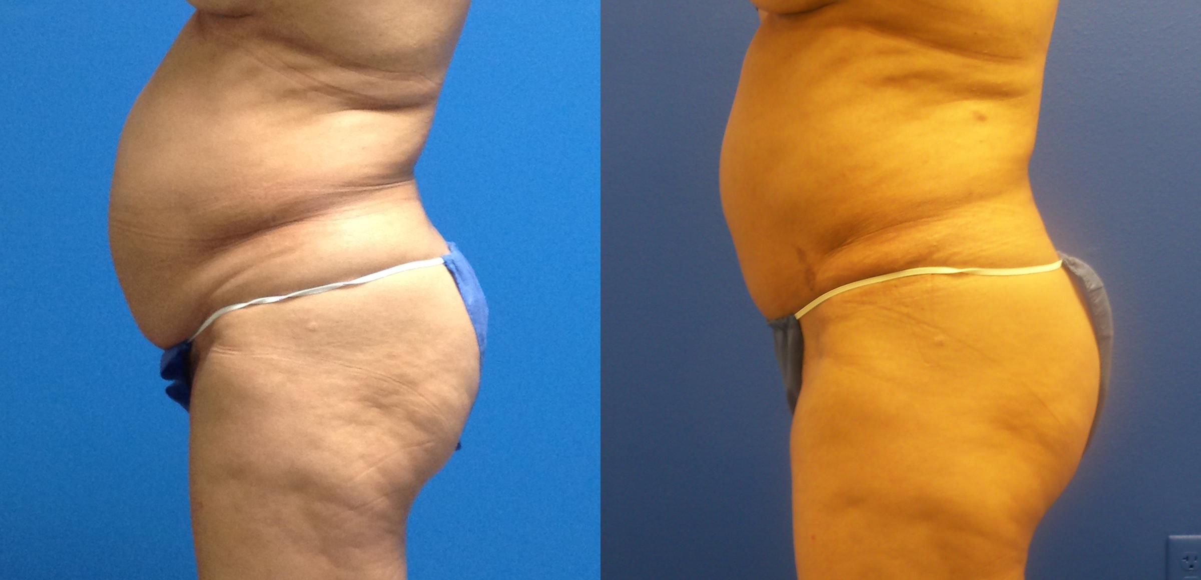 Hidden Tummy Tuck Before & After Gallery - Patient 223176 - Image 3