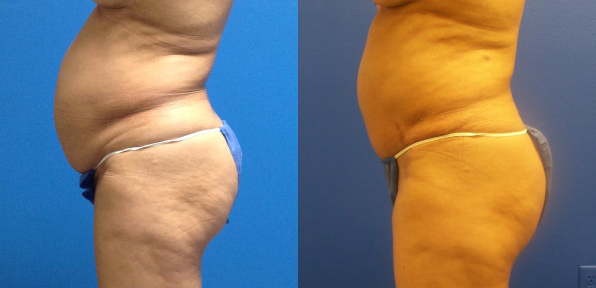 Tummy Tuck Before & After Gallery - Patient 238407 - Image 3