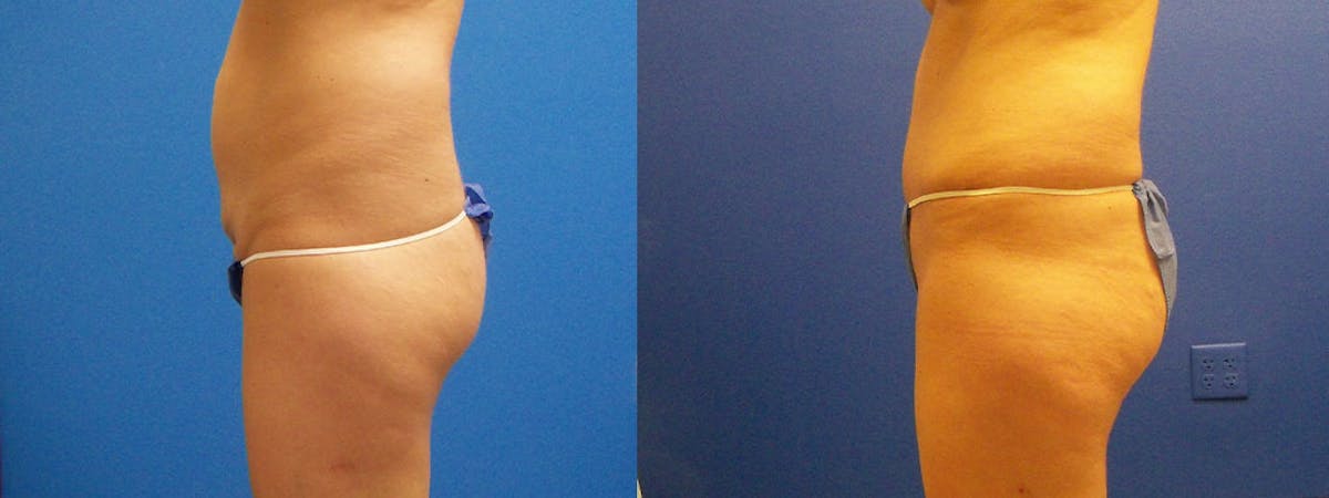 Drainless Tummy Tuck Before & After Gallery - Patient 122406723 - Image 2