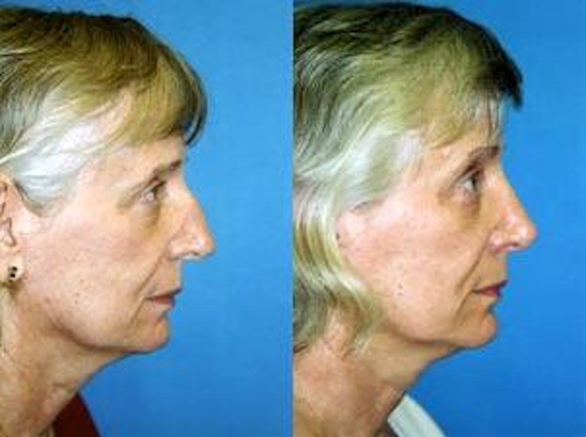 Rhinoplasty Before & After Gallery - Patient 122406724 - Image 1