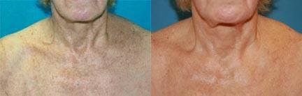 Skin Resurfacing Before & After Gallery - Patient 122406726 - Image 1