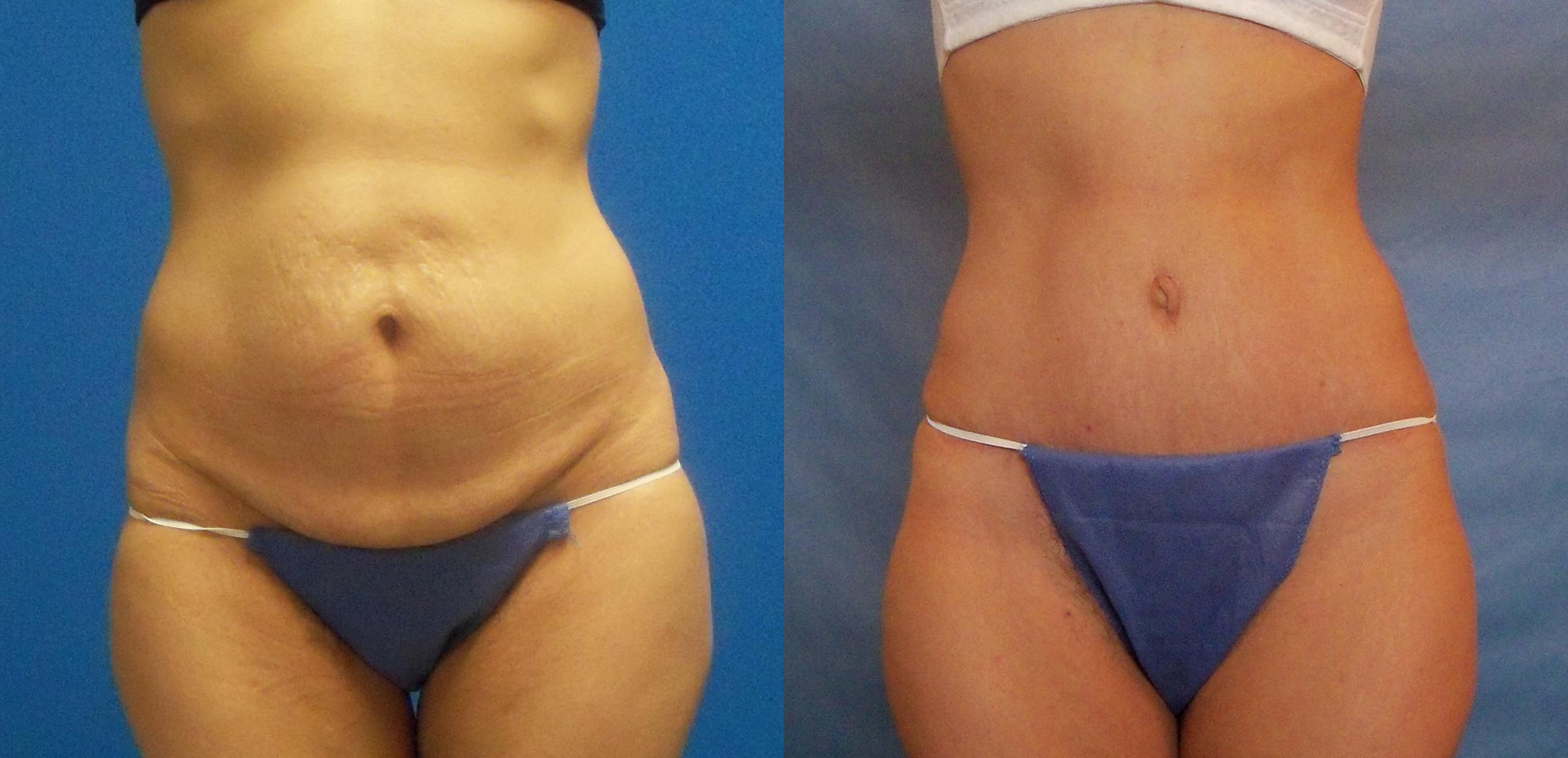 Hidden Tummy Tuck Before & After Gallery - Patient 288122 - Image 1