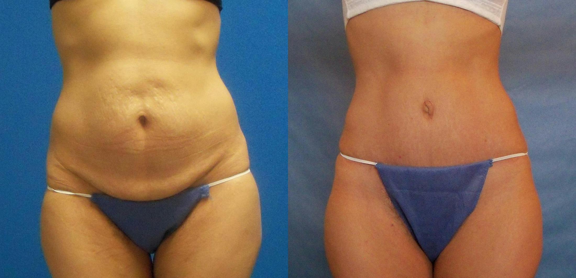 Hidden Tummy Tuck Before & After Gallery - Patient 288122 - Image 1