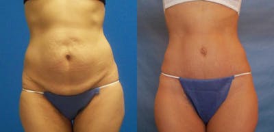 Hidden Tummy Tuck Before & After Gallery - Patient 288122 - Image 1