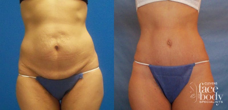 Hidden Tummy Tuck Before & After Gallery - Patient 288122 - Image 1