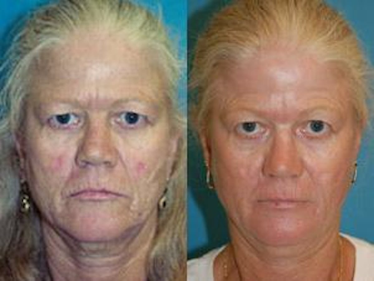 Skin Resurfacing Before & After Gallery - Patient 122406729 - Image 1