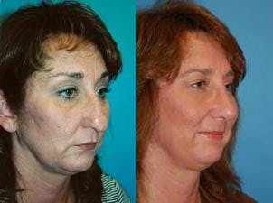 Rhinoplasty Before & After Gallery - Patient 122406727 - Image 2