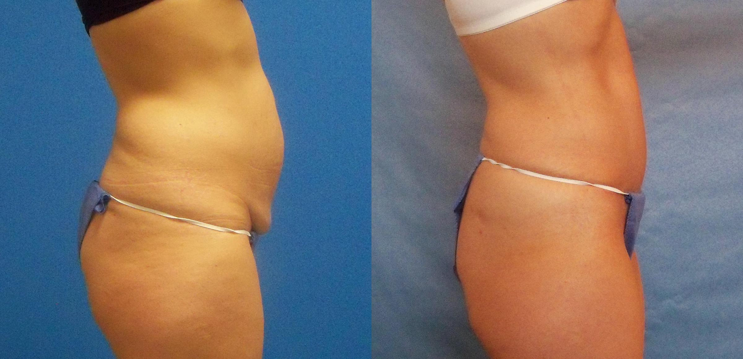 Hidden Tummy Tuck Before & After Gallery - Patient 288122 - Image 2