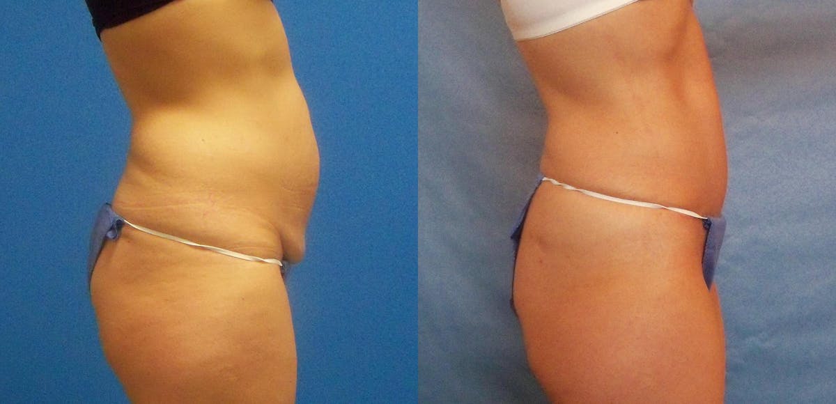 Tummy Tuck Before & After Gallery - Patient 467536 - Image 2