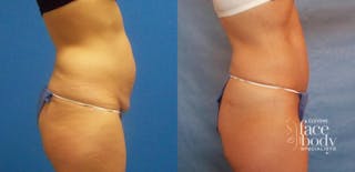 Hidden Tummy Tuck Before & After Gallery - Patient 288122 - Image 2