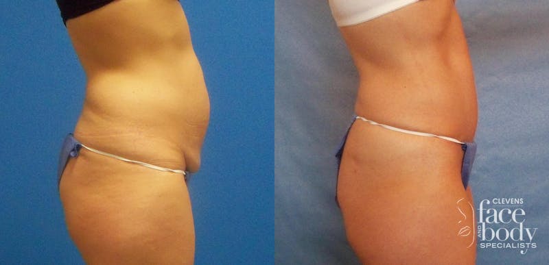 Hidden Tummy Tuck Before & After Gallery - Patient 288122 - Image 2