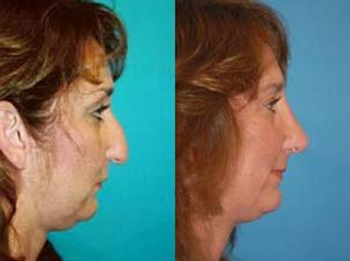 Rhinoplasty Before & After Gallery - Patient 122406727 - Image 3