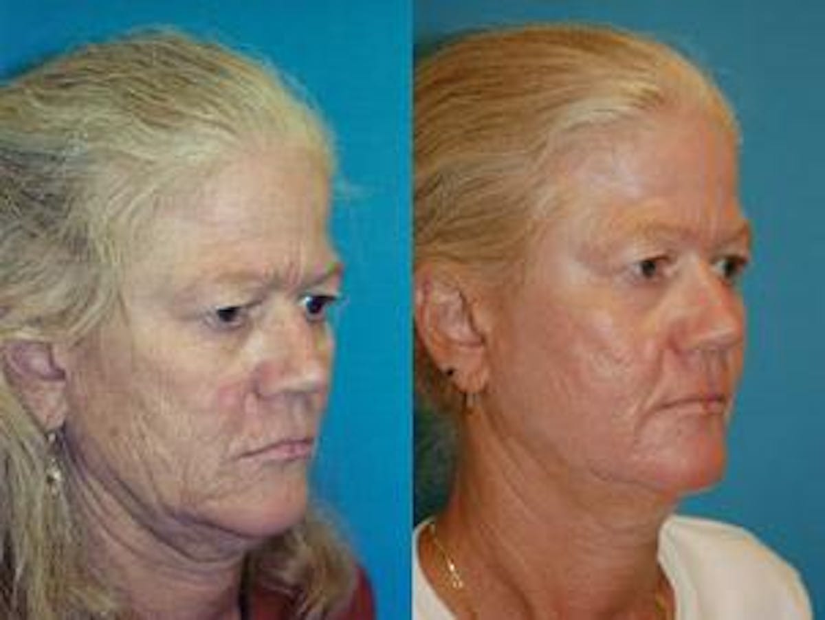 Skin Resurfacing Before & After Gallery - Patient 122406729 - Image 2